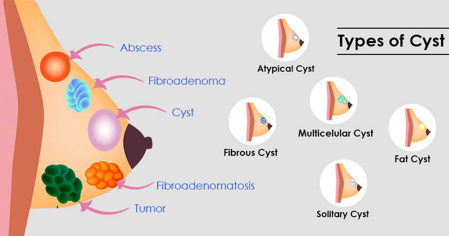 fibroadenoma breast